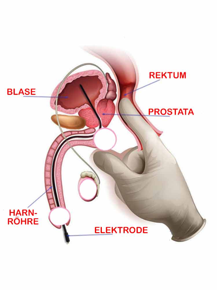 E-Stim-Silikon Dilator 35cm x 5.5mm